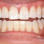 Composite Build Up
